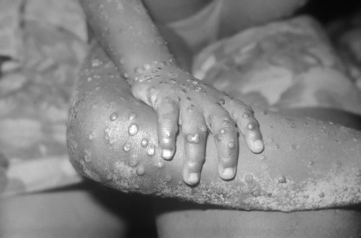 mpox i Sverige